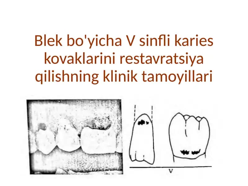 Blek 5-sinf. Karies kovaklarini restavratsiya qilishning klinik tamoyillari