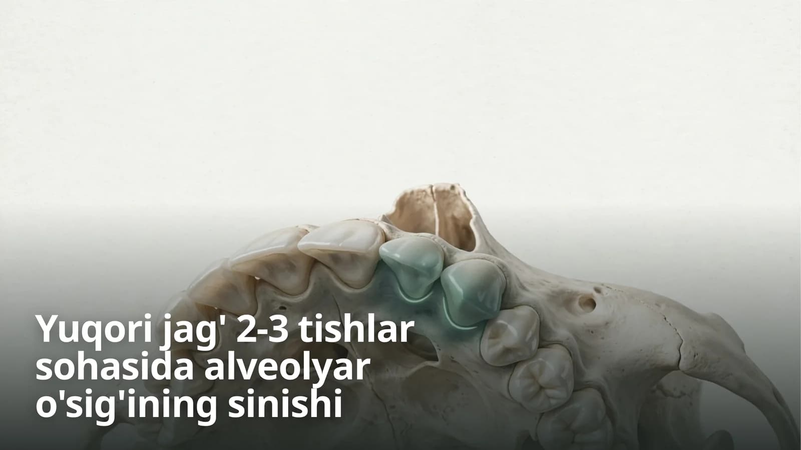 Yuqori jag’ 2-3tishlar sohasida alveolyar o’sig’ining sinishi