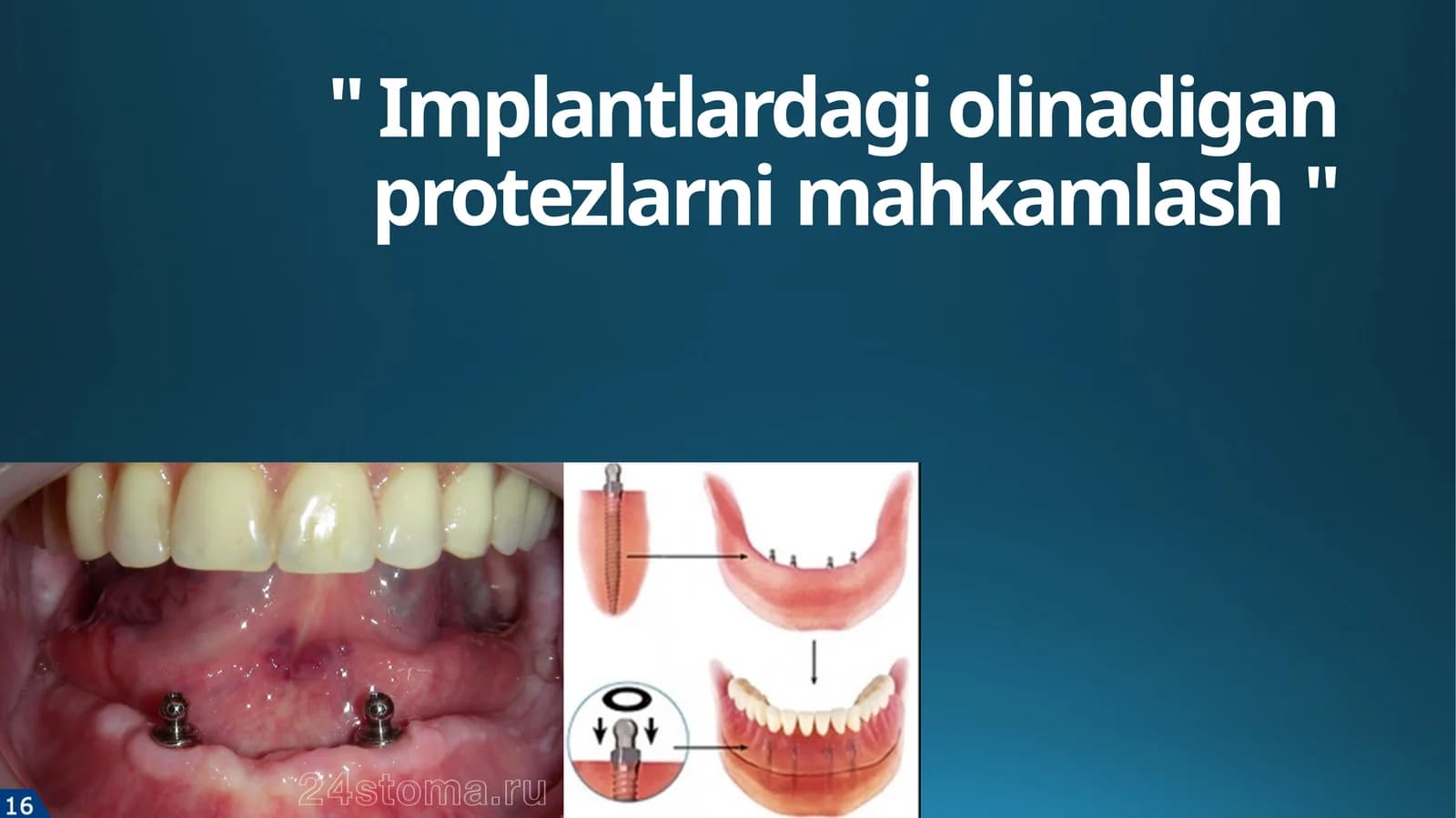 To'liq olib qo'yiladigan protezlarni implantlar bilan fiksatsiya qilish turlari