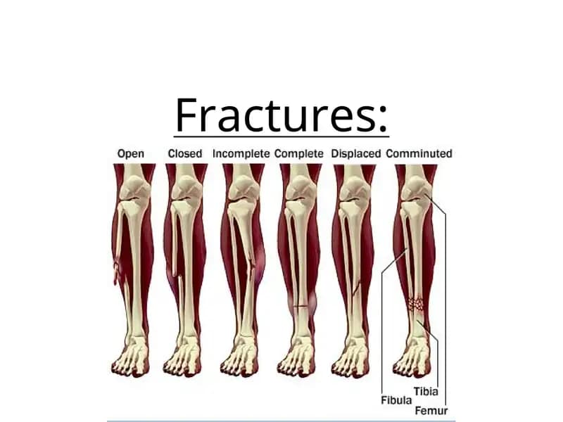 Fractures