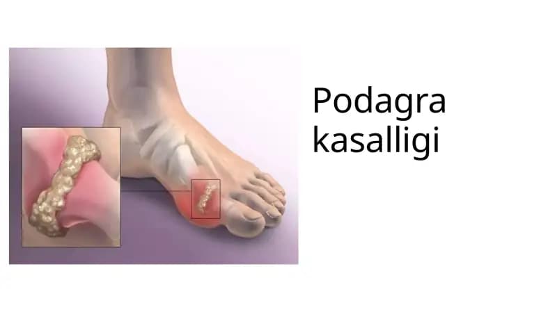 Podagra