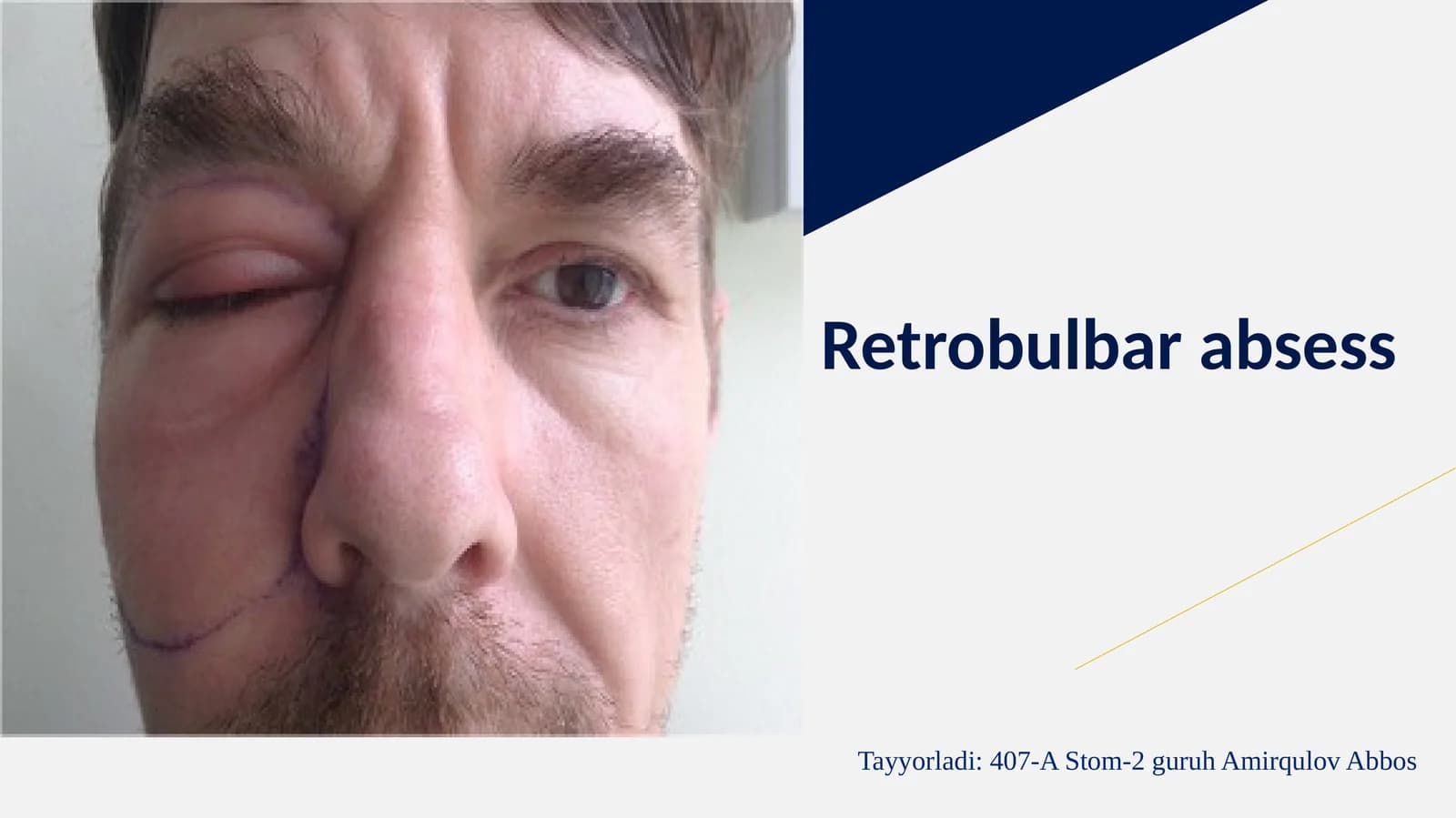 Retrobulbarabsess