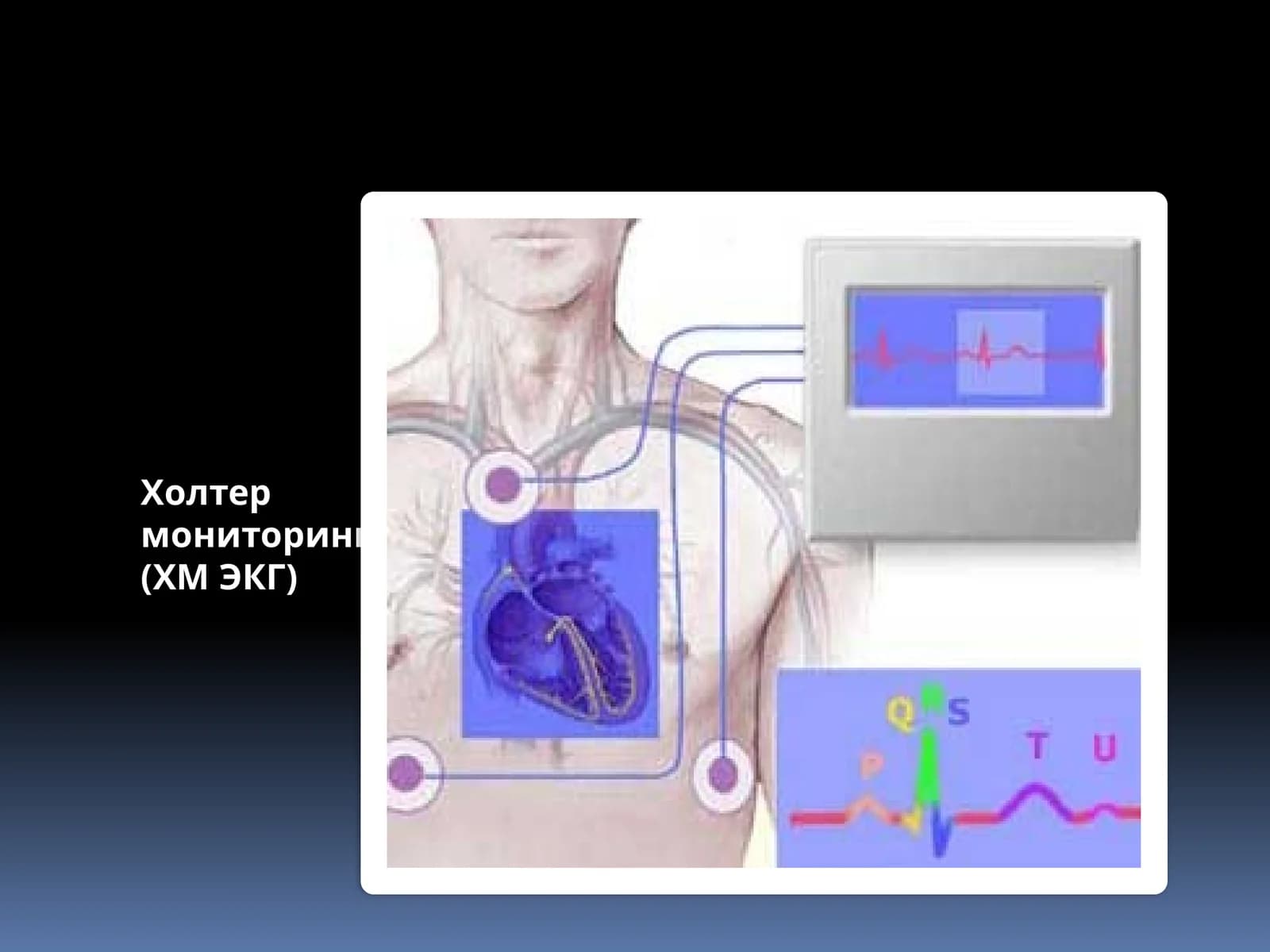 Холтермониторинги (ХМ ЭКГ)