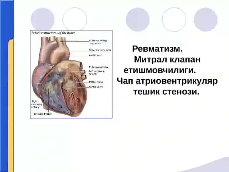 Ревматизм