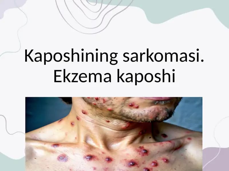Kaposhining sarkomasi. Ekzema kaposhi