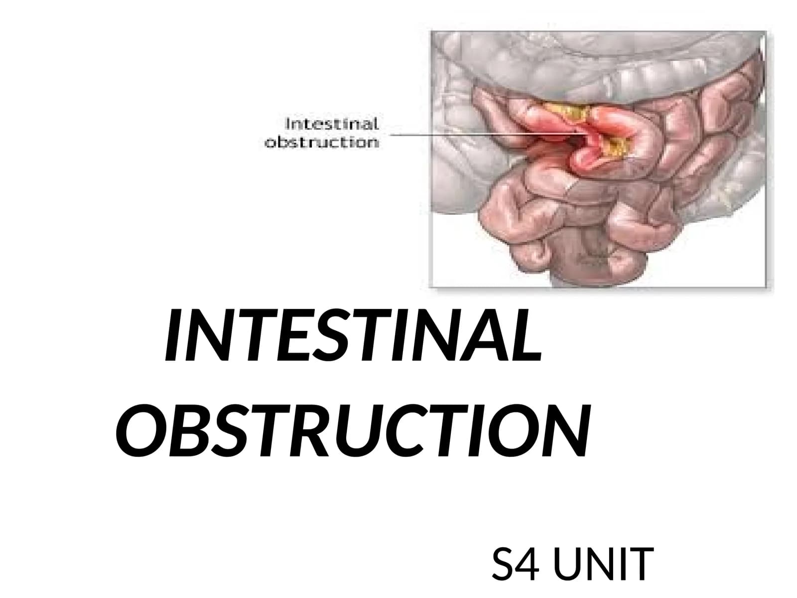 INTESTINAL OBSTRUCTION