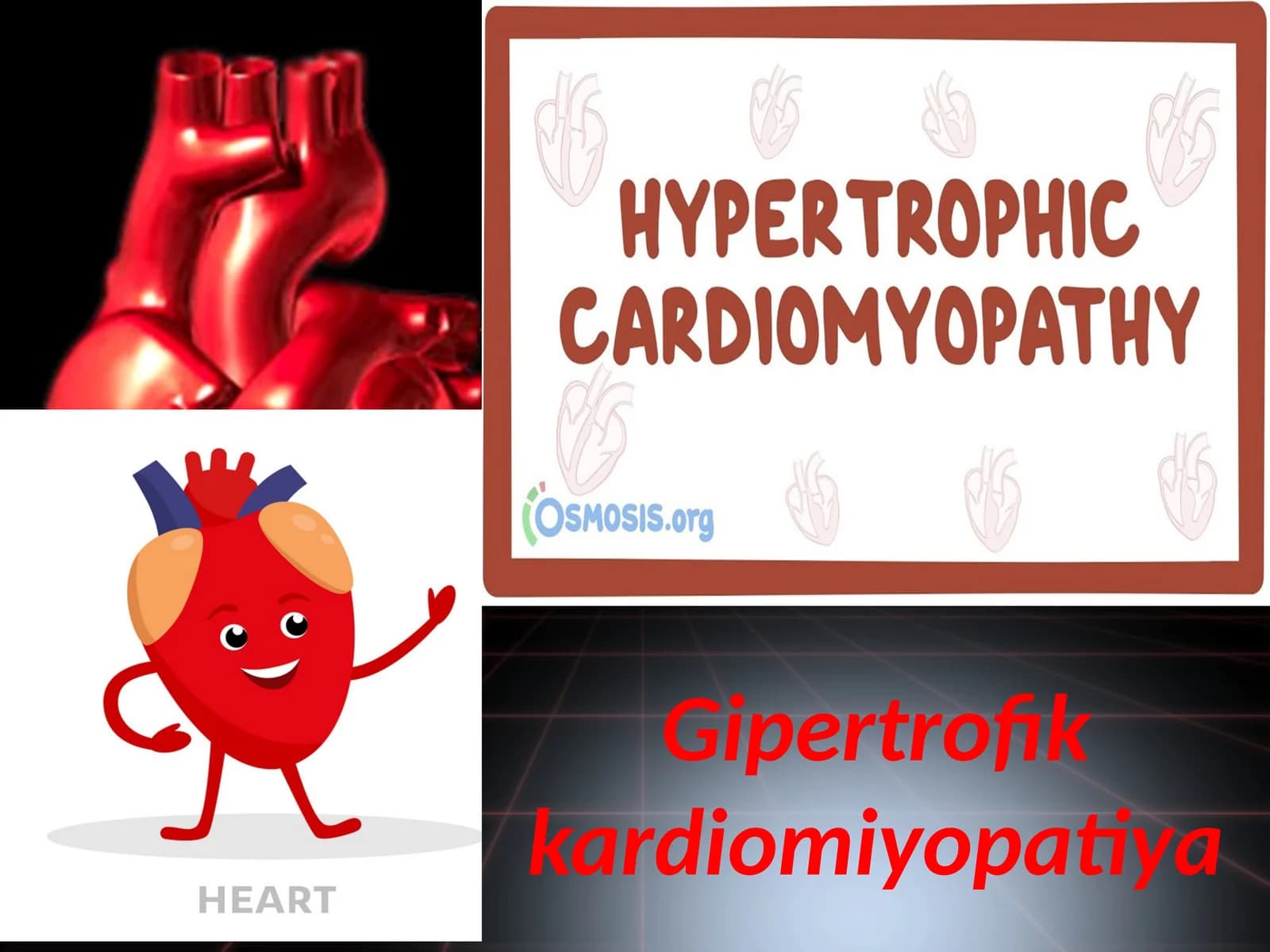 Gipertrofik kardiomiyopatiya