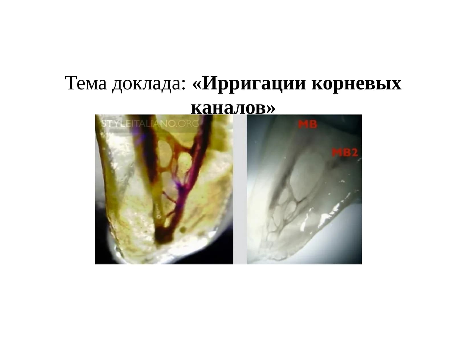 Ирригации корневых каналов
