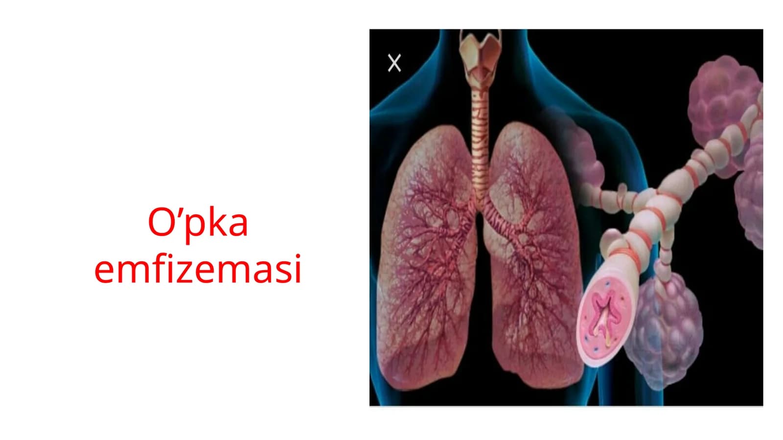 O’pka emfizemasi