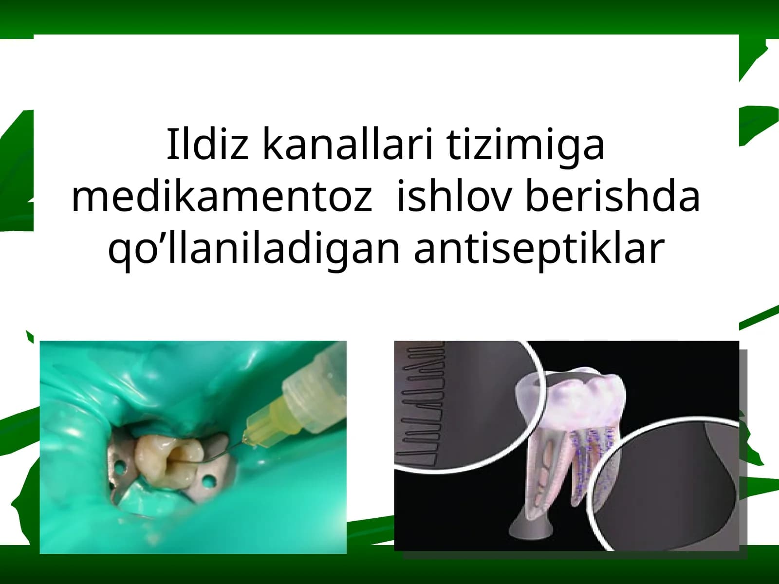 Ildiz kanallari tizimiga medikamentoz  ishlov berishda qo’llaniladigan antiseptiklar