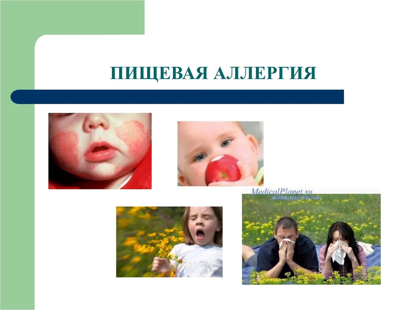 Пищевая аллергия