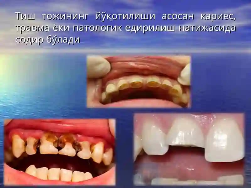 Тиш  тож  қисмининг  қисман ва  тўлиқ йўқотилганда   ўзакли конструкциялар билан тиклаш.