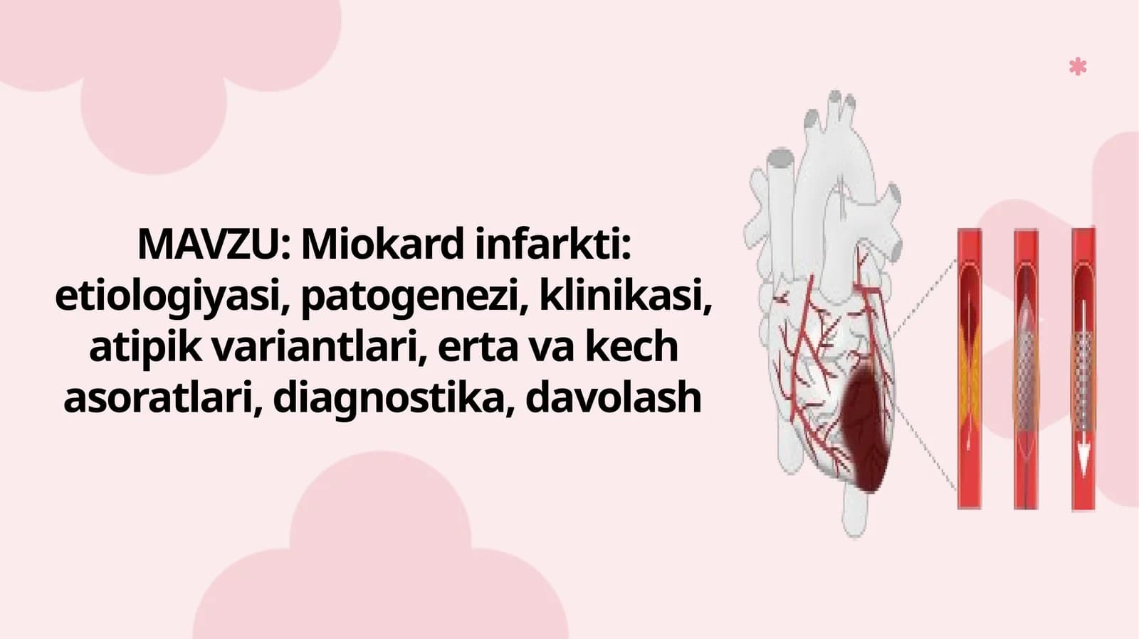 Miokard infarkti