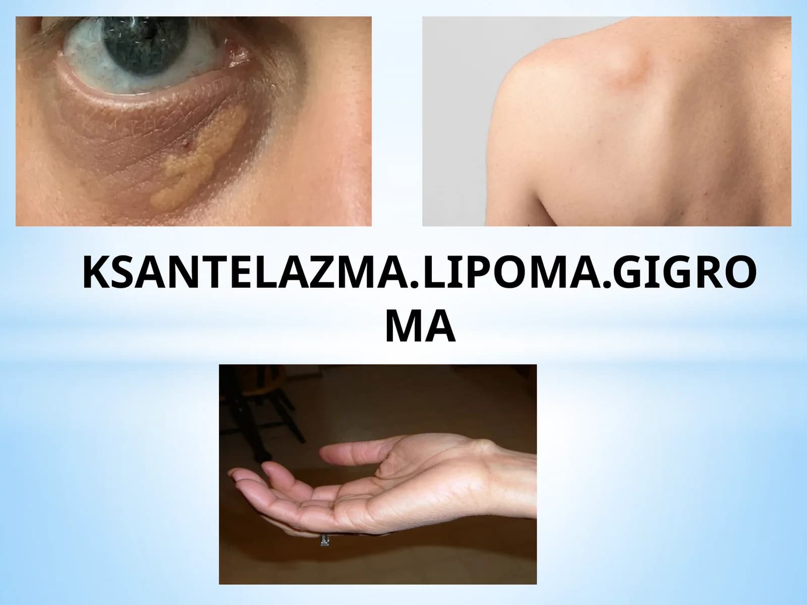 KSANTELAZMA.LIPOMA.GIGROMA