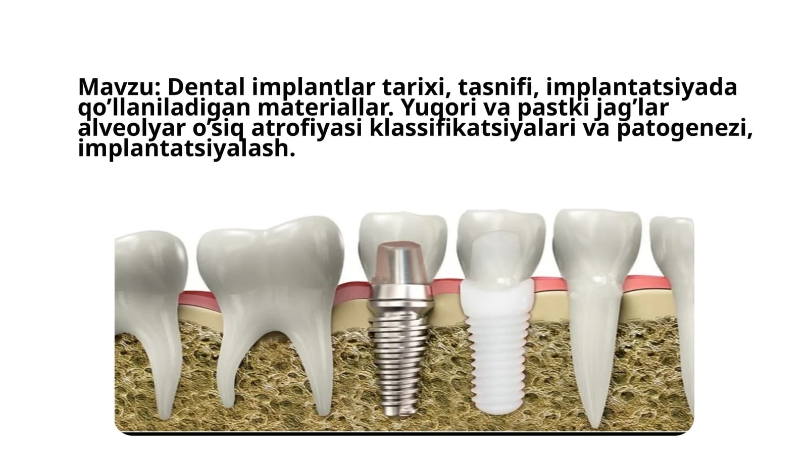 Dentalimplantlar tarixi