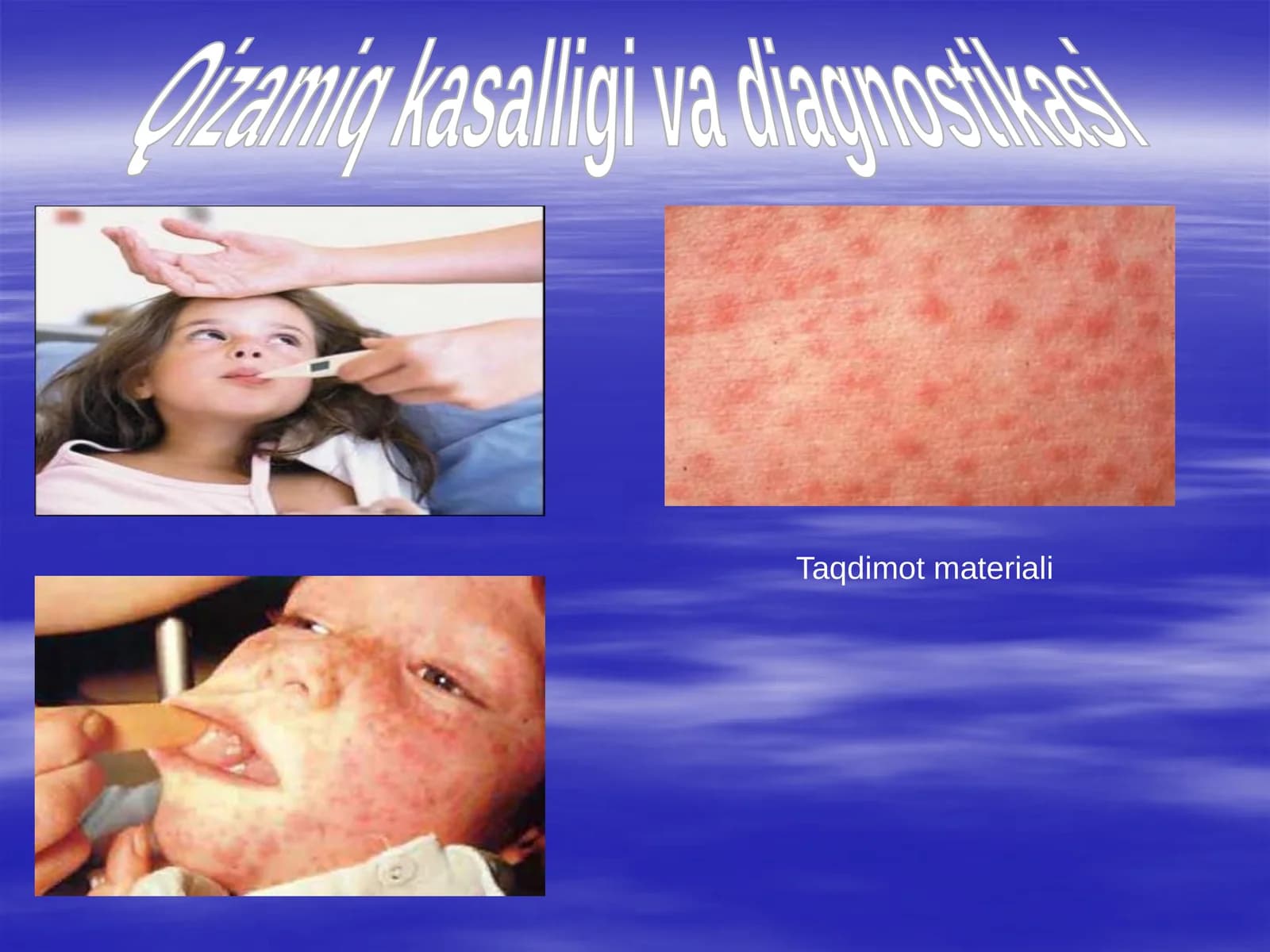 Qizamiq kasalligi va diagnostikasi