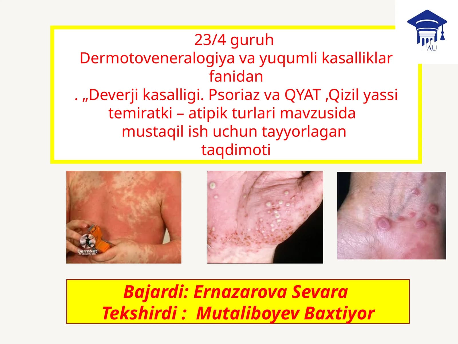 Deverjikasalligi, Psoriaz va Qizilyassi temiratki