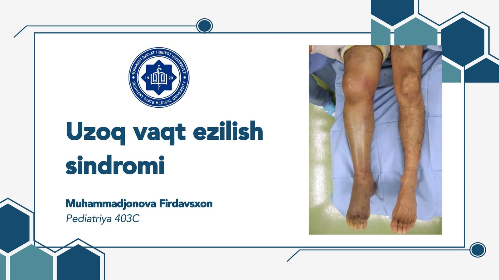 Uzoq vaqt ezilish sindromi