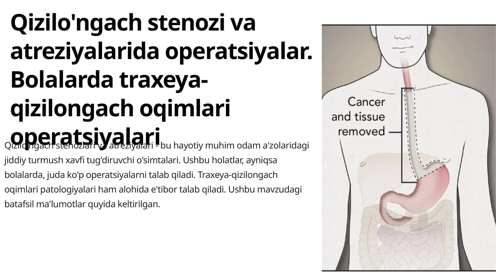 Qizilo'ngach stenozi va atreziyalarida operatsiyalar. Bolalarda traxeya-qizilongach oqimlari operatsiyalari