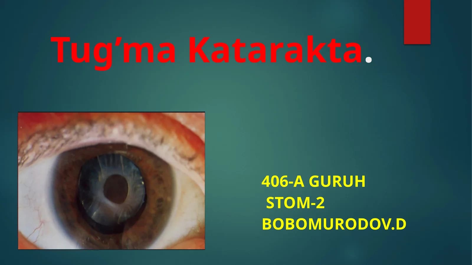 Tug'ma katarakta
