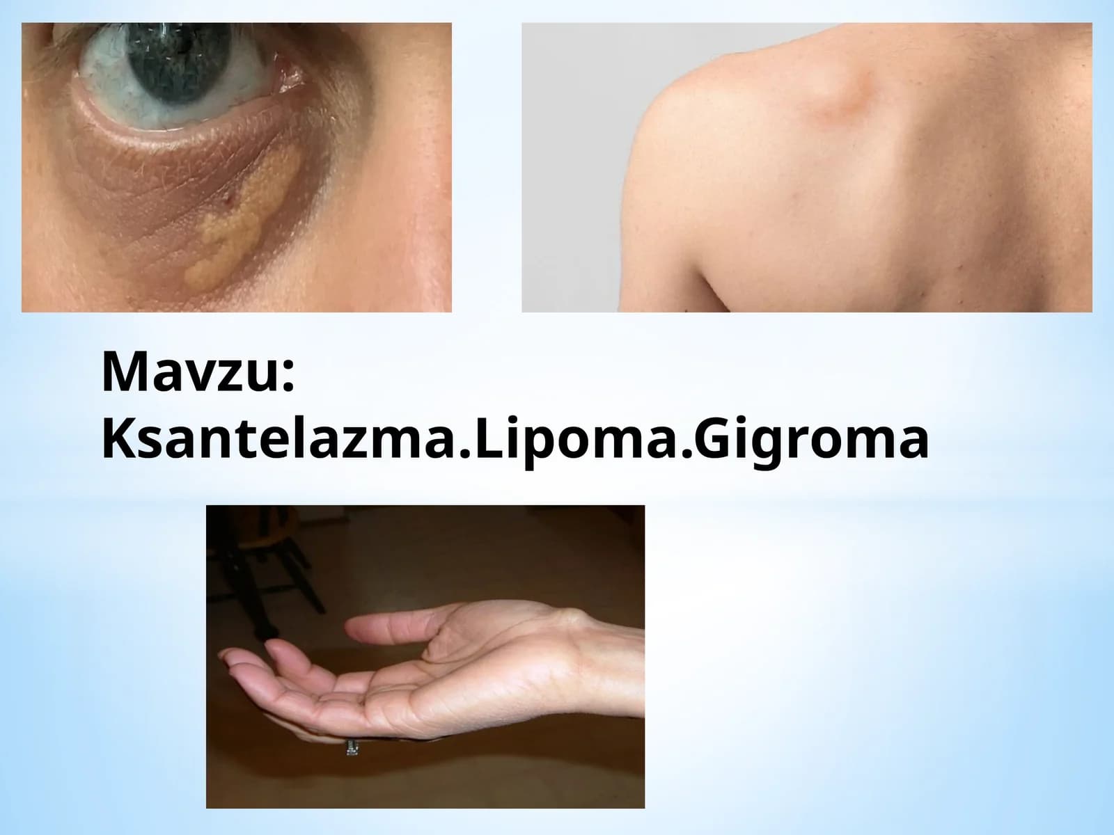 Ksantelazma.Lipoma.Gigroma