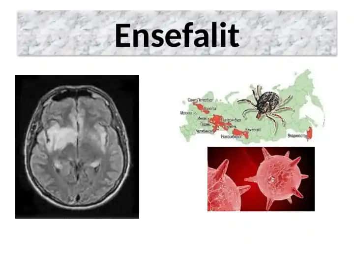 Ensefalit