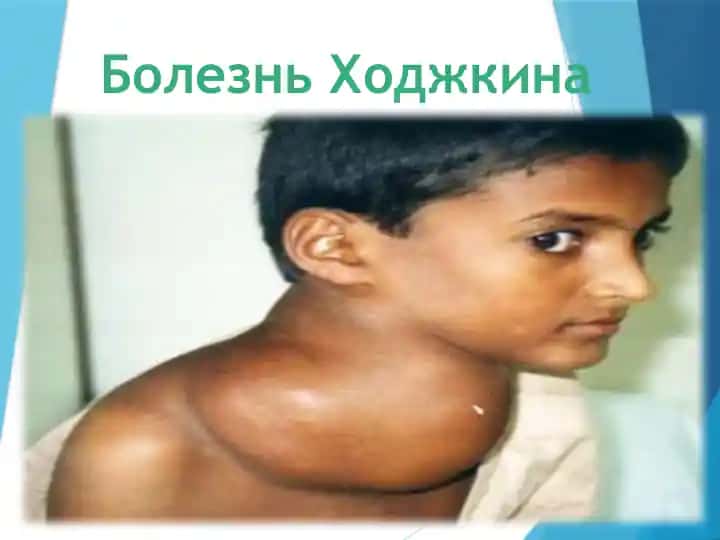 Лимфогранулематоз или болезнь Ходжкина