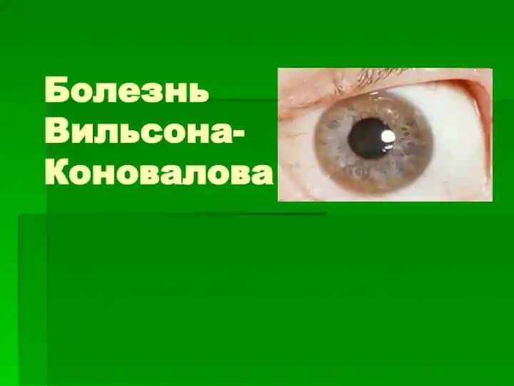 Болезнь Вильсона-Коновалова
