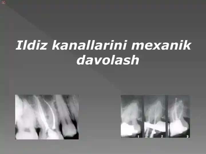 Endodontik Davolash Standarti