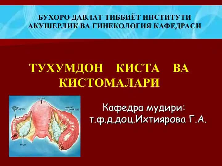 ТУХУМДОН КИСТА ВА КИСТОМАЛАРИ