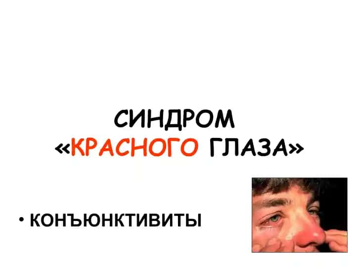 Конъюнктивиты