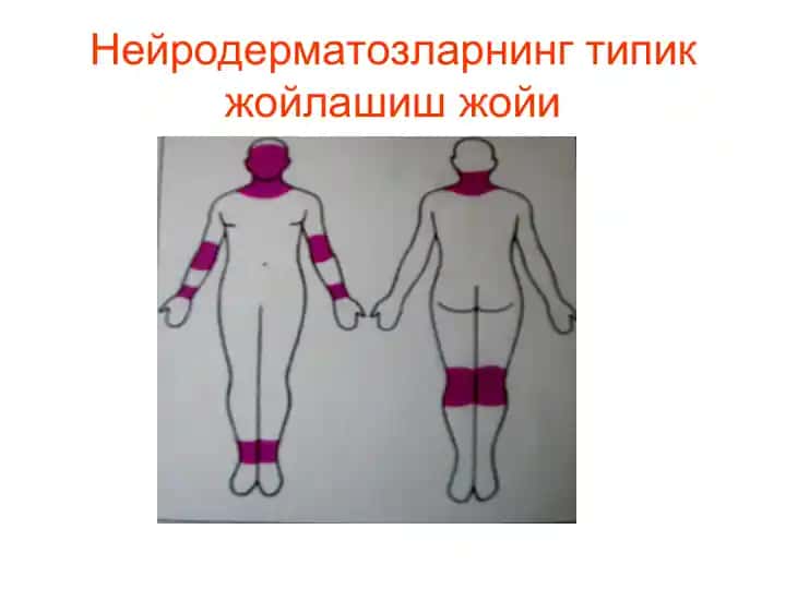 Нейродерматозларнинг типик жойлашиш жойи