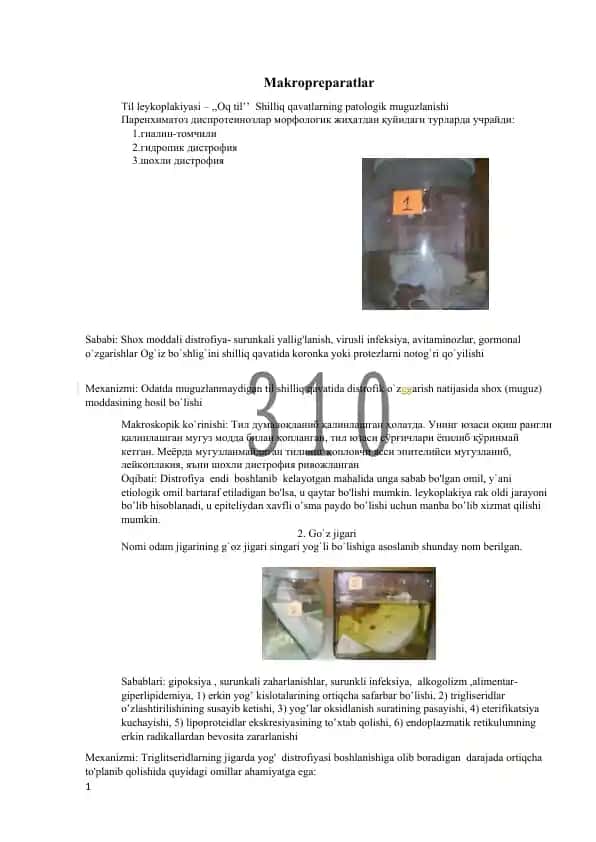 Til leykoplakiyasi – ,,Oq til’’ Shilliq qavatlarning patologik muguzlanishi