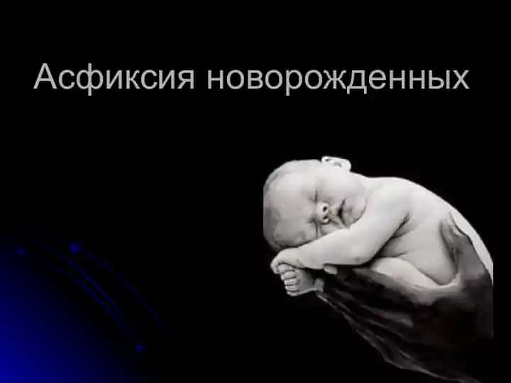 Асфиксия новорожденных
