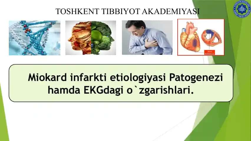 Miokard infarkti etiologiyasi Patogenezi hamda EKGdagi o`zgarishlari