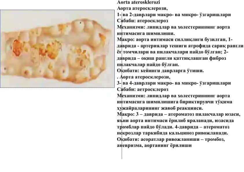 Aorta aterosklerozi