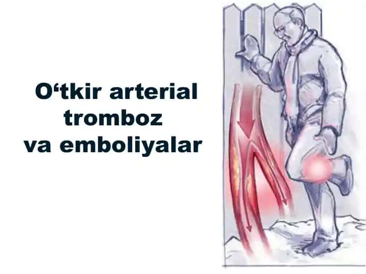 O‘tkir arterial tromboz va emboliyalar