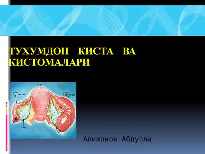 Тухумдон киста ва кистомалари