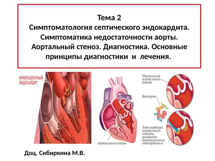 Бактериальный септический эндокардит, определение