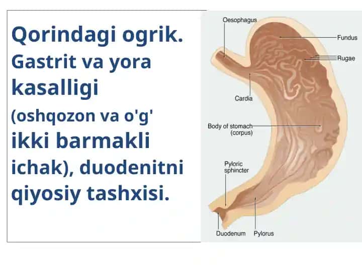 Surunkali gastrit va o'q barmaqli ichak yara kasalligi