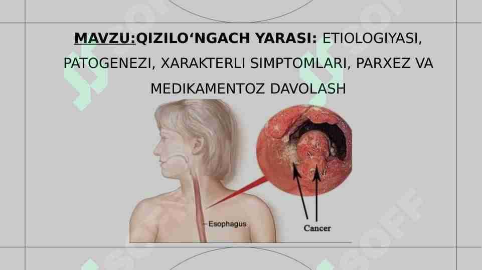 QIZILO‘NGACH YARASI ETIOLOGIYASI, PATOGENEZI, XARAKTERLI SIMPTOMLARI, PARXEZ VA MEDIKAMENTOZ DAVOLASH