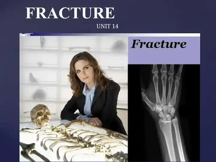 Fracture