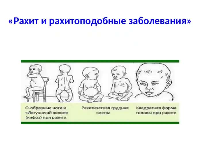 Рахит и рахитоподобные заболевания