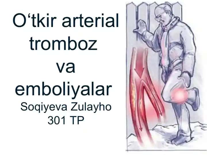 O‘tkir arterial tromboz va emboliyalar