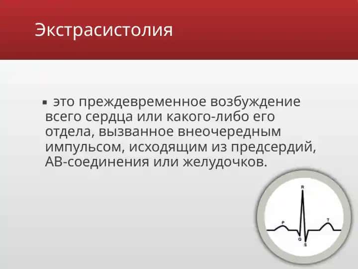 Экстрасистолия