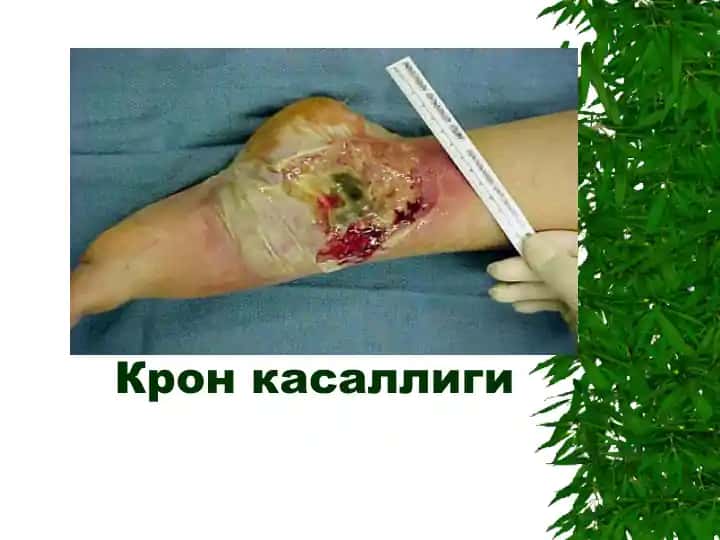 Крон касаллиги (Crohn's disease)
