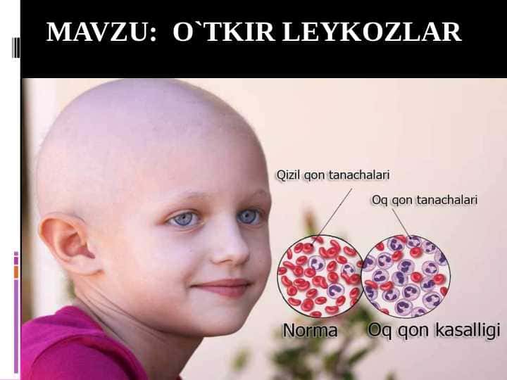 O'TKIR LEYKOZLAR