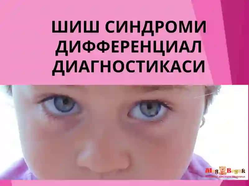 ШИШ СИНДРОМИ ДИФФЕРЕНЦИАЛ ДИАГНОСТИКАСИ. Shish sindromi differensial diagnostikasi
