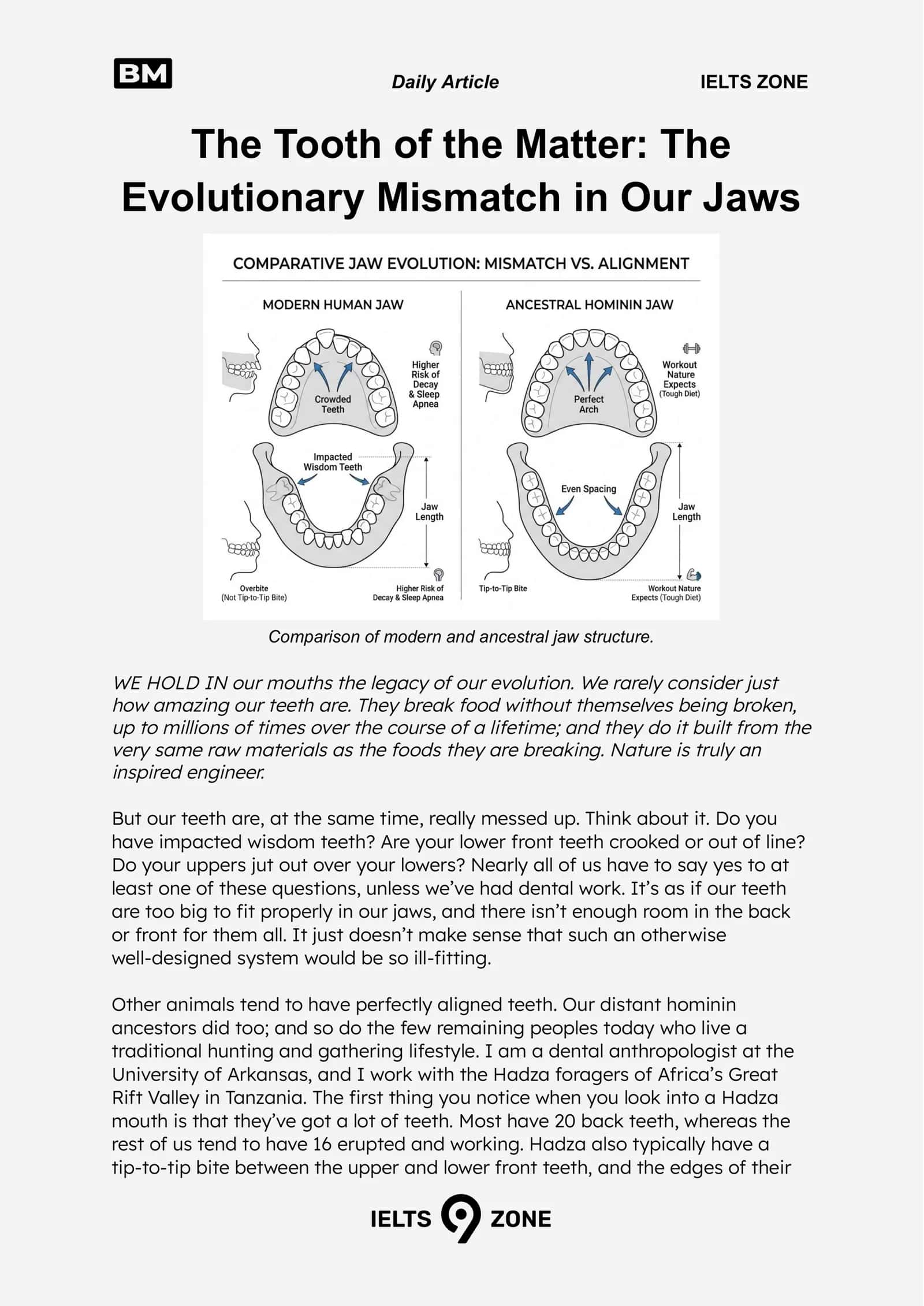 The Tooth of the Matter: The Evolutionary Mismatch in Our Jaws