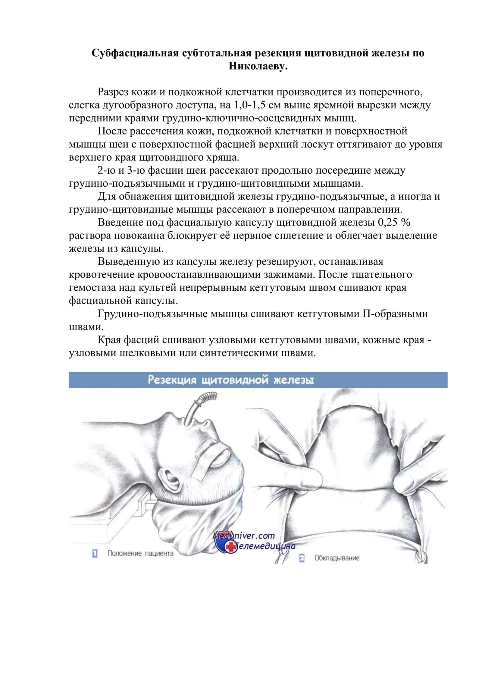 Субфасциальная субтотальная резекция щитовидной железы по Николаеву